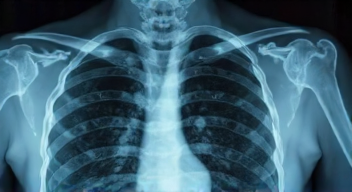 Die 6 häufigsten Fehler bei der Mammografie